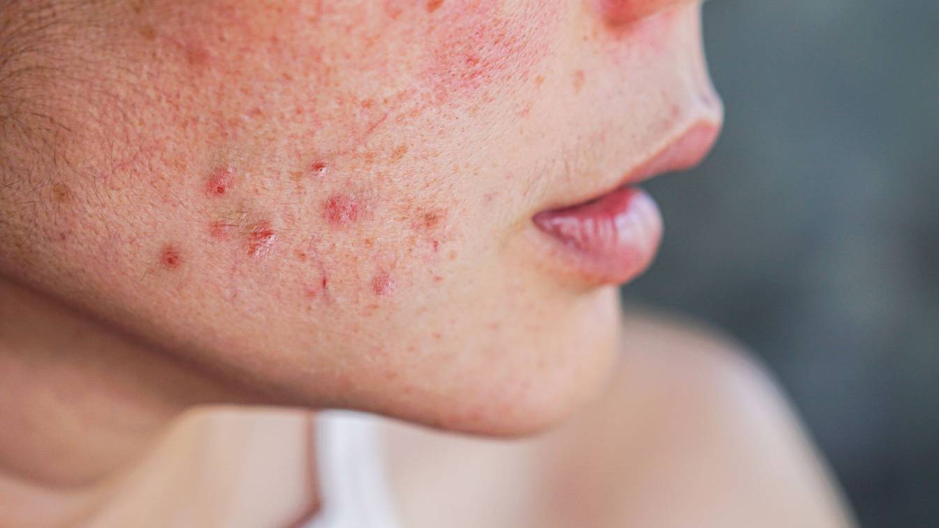What To Know About Hormonal Acne